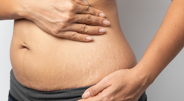 پوست کرم ترک پوستی برای ترک های ناشی از سوختگی