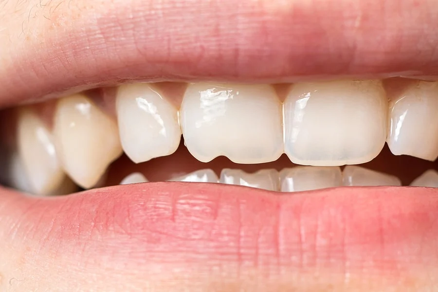در صورت بروز شکستگی های جزئی، ترمیم لمینت با سوهان&zwnj;کشی قابل انجام است.